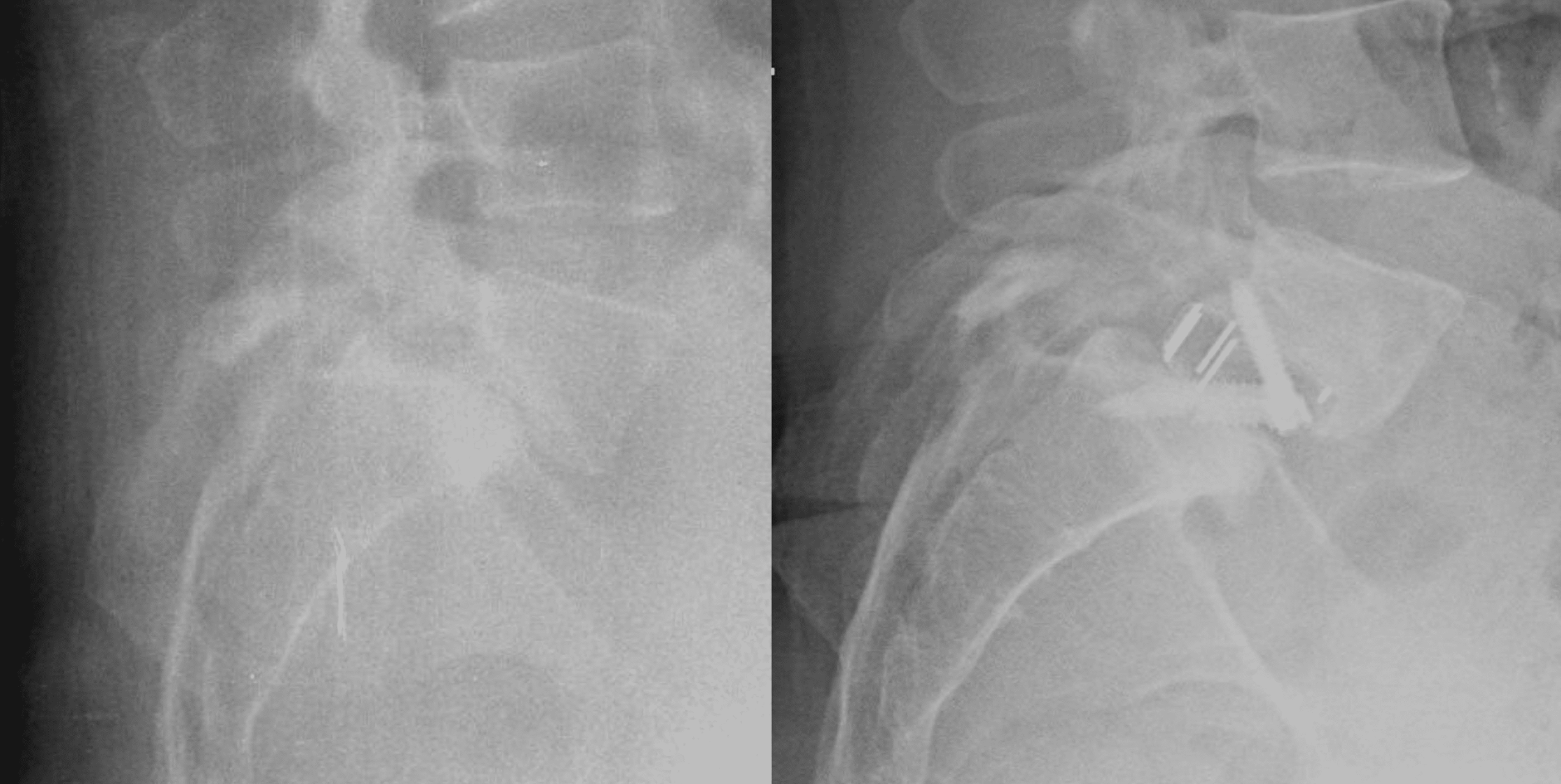 alif standalone in isthmic spondylolisthesis